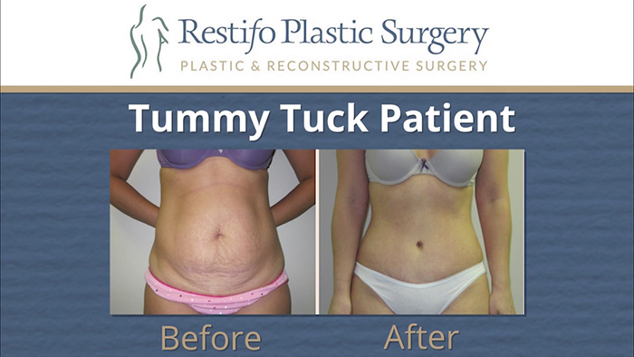 Suck or tuck? Tummy tuck results.