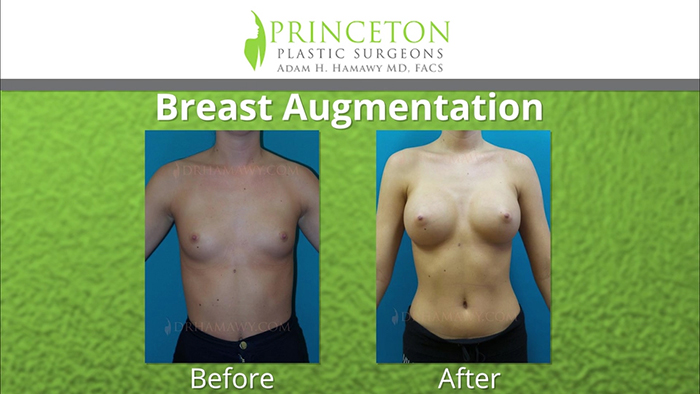 Breast augmentation results - Dr. Hamawy.