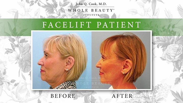 Facelift results - Dr. Cook.