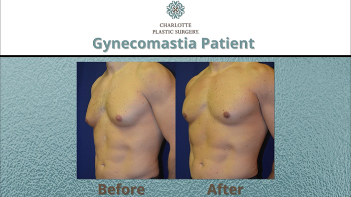 Gynecomastia results - Dr. Nyame.