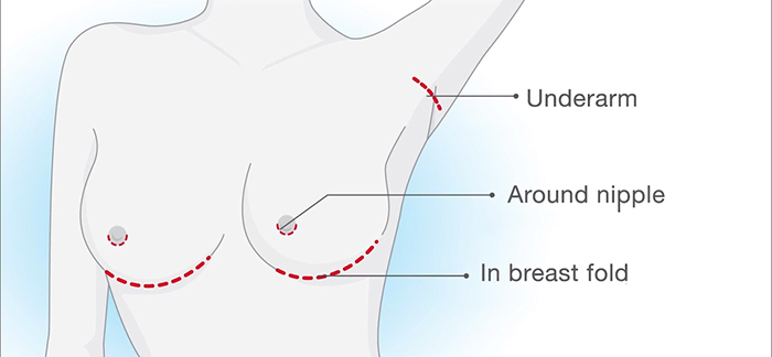 Incision locations.