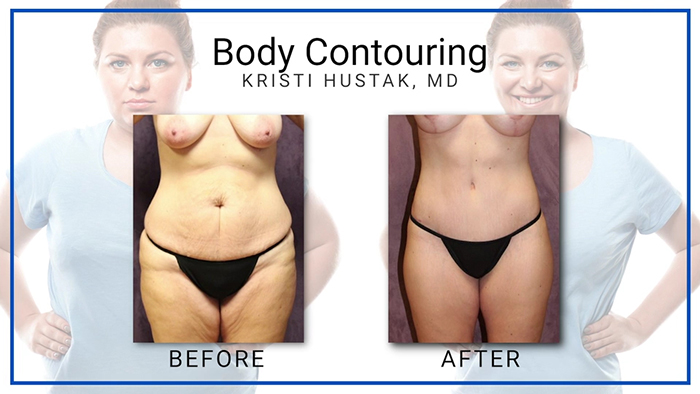 Body contouring results - Dr. Hustak.