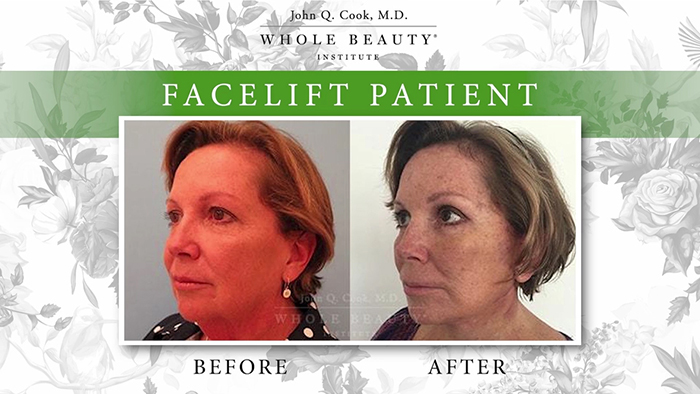 Facelift under local patient.