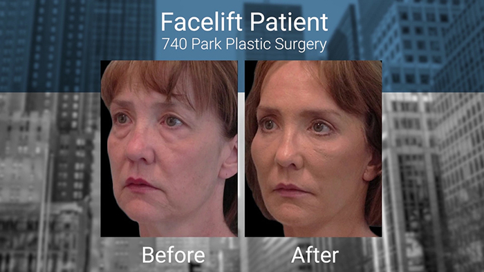 Facelift patient- Dr. Broumand.