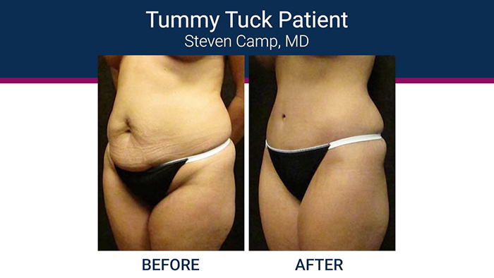 High definition tummy tuck patient - Dr. Camp.