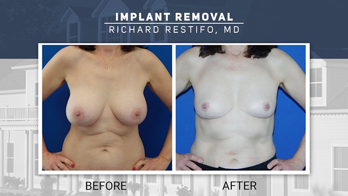 Breast implant removal patient - Restifo.,