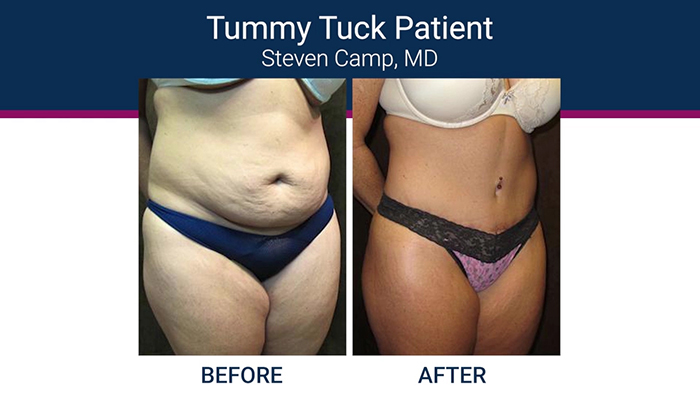 High definition tummy tuck patient.