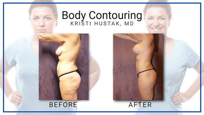 Hustak body contouring BnA.