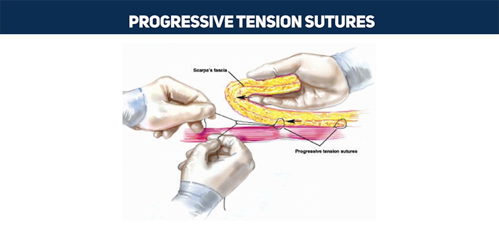 Progressive tension sutures in a high definition tummy tuck.