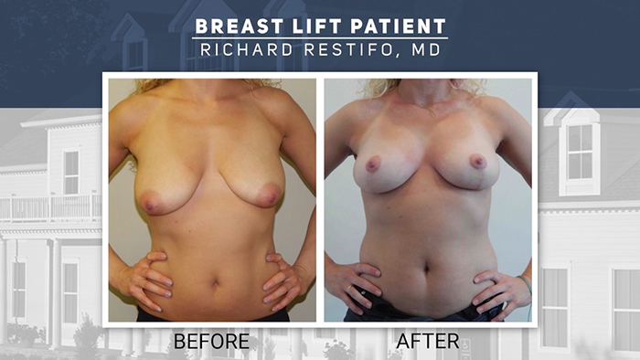 Breast implant removal patient - Restifo.,