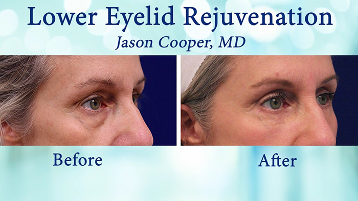 Eyelid correction - Dr. Cooper.