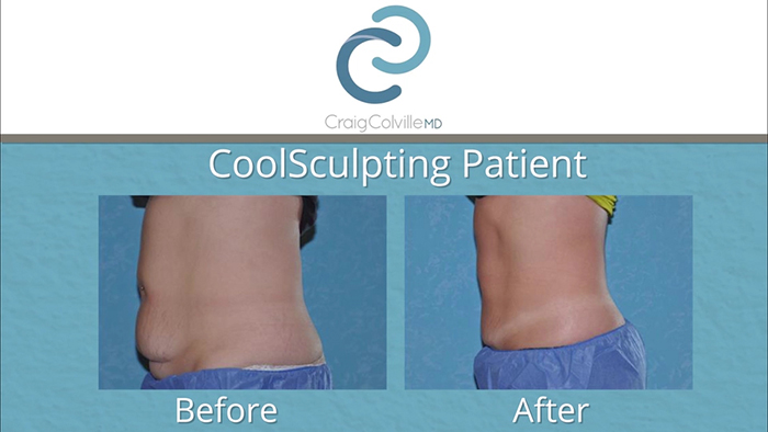 Dr. Colville CoolSculpting results.