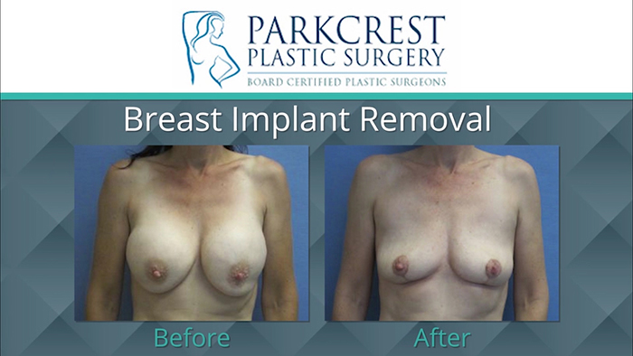 Implants removed - results.