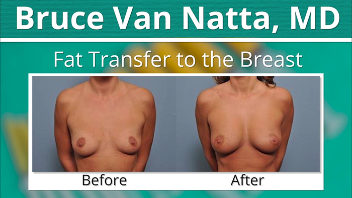 Results of fat grafting to the breast.