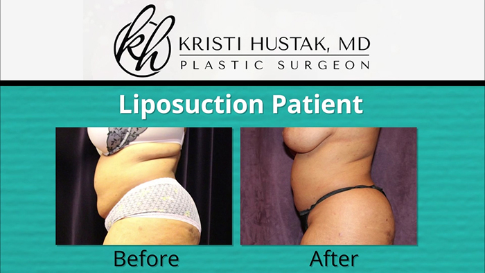 Liposuction patient - Dr. Hustak.
