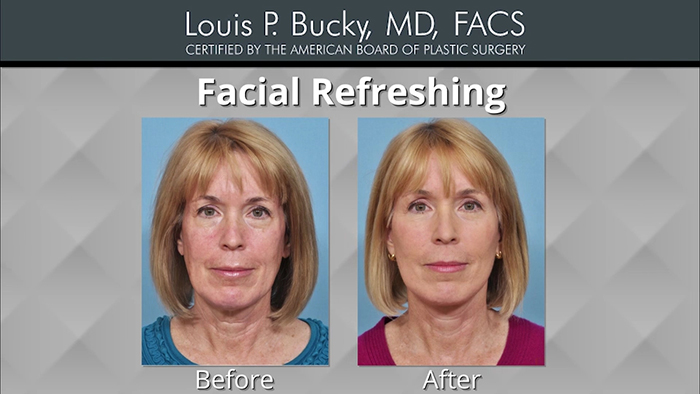 Facial refreshing results - Bucky.