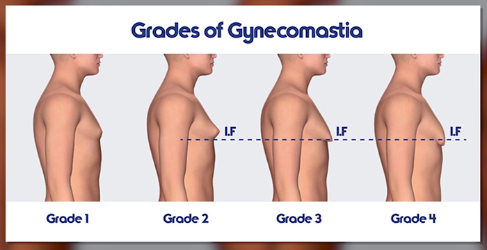 Types of enlarged male breasts.