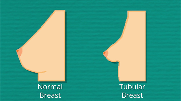 Fixing tuberous breasts with fat.