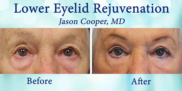 Midface lift - eyelid correction.