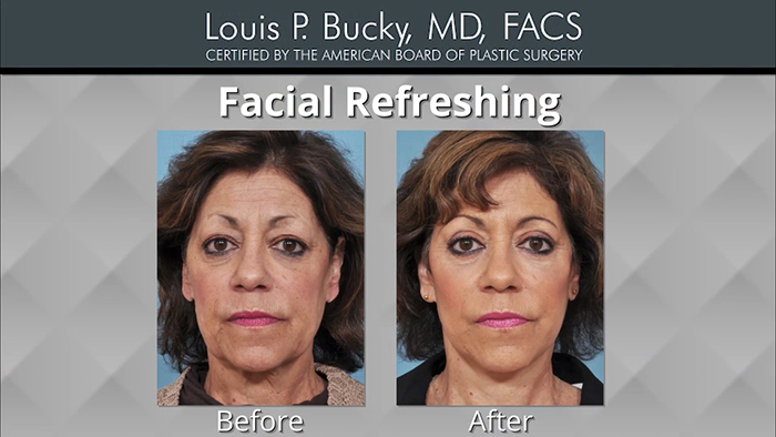 Facial refreshing results.