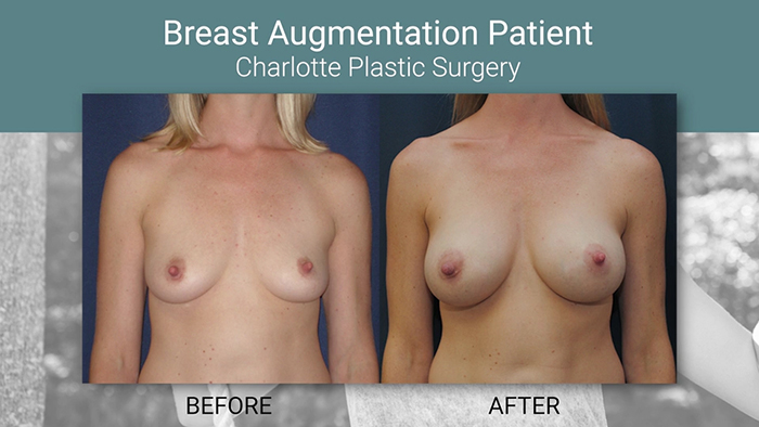 Breast augmentation before and after - Stephan Finical.