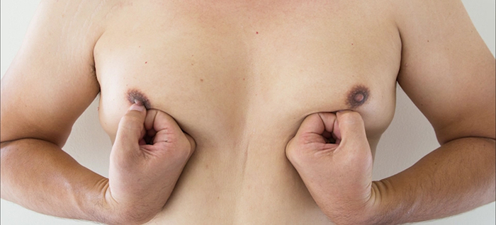 Gynecomastia issues.