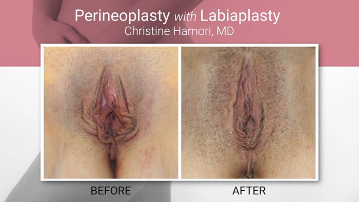 Perineoplasty results.