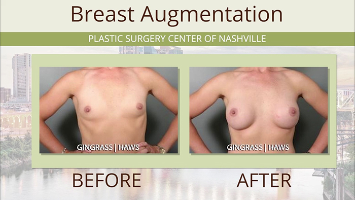 Breast augmentation results - Gingrass.