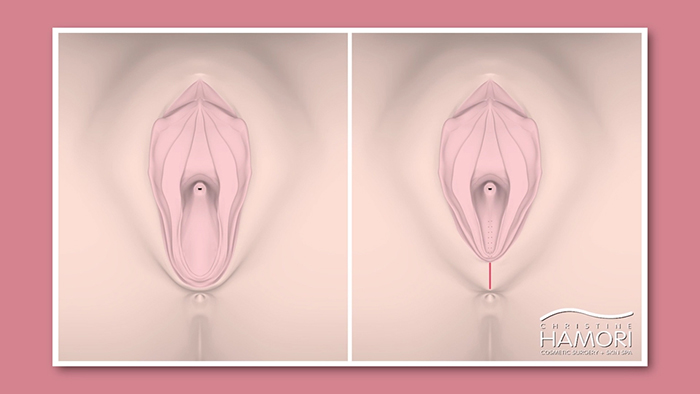 Perineoplasty overview.