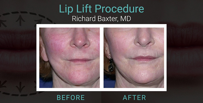 Lip lift patient - Dr. Baxter.