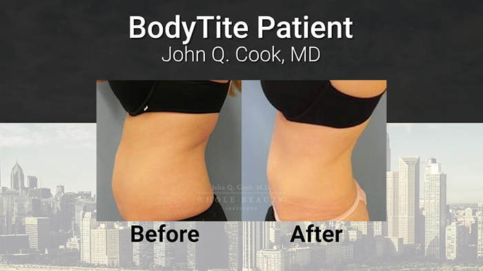 BodyTite results - Dr. Cook.