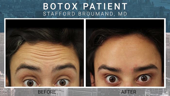 Botox patient of Dr. Broumand.