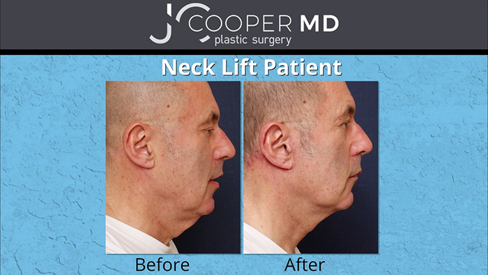 Neck lift results - Dr. Cooper.