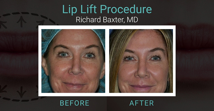 Lip lift results.