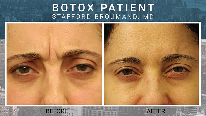 Botox treatment with Dr. Broumand.