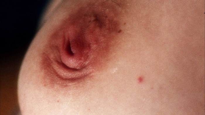 Inverted nipple example.