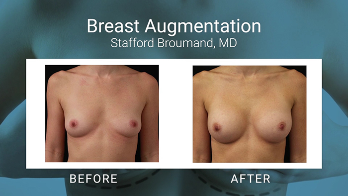 Breast augmentation - Dr. Stafford Broumand.