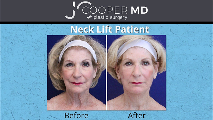 Dr. Cooper - Neck lift patient.