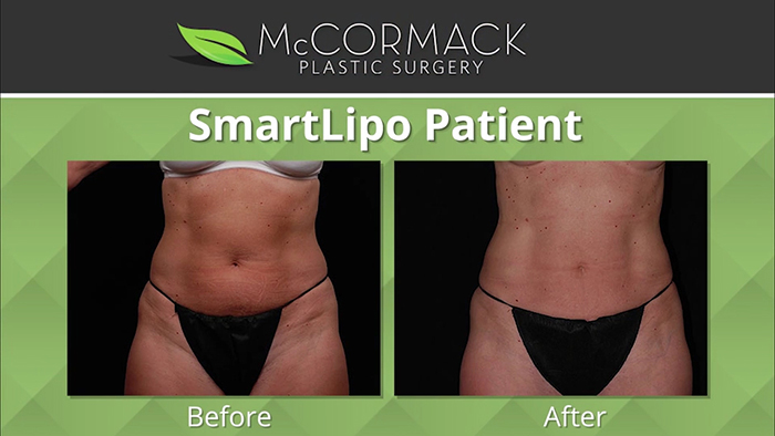 Smartlipo - Surgery add-ons.