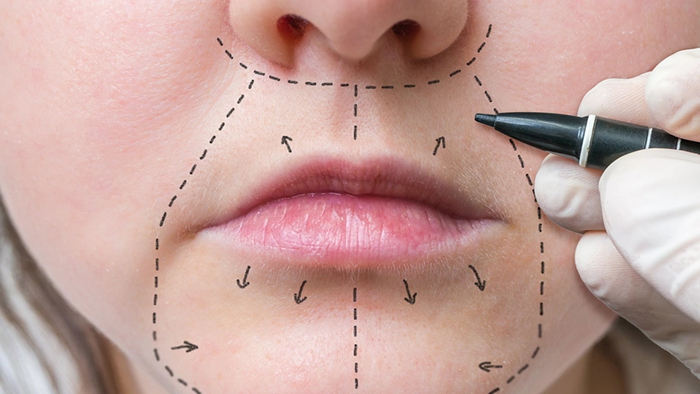 Lip lift overview.