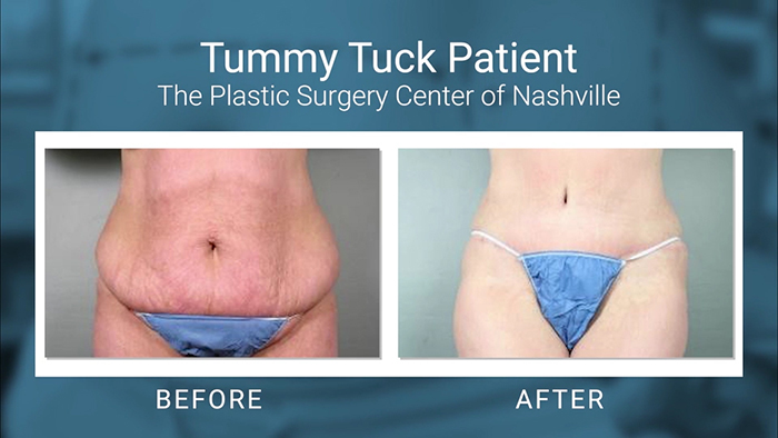 Tummy tuck patient - Dr. Gingrass.