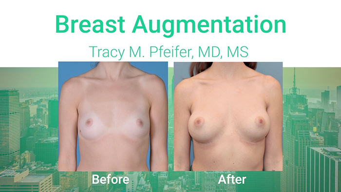 Breast augmentation with Dr. Pfeifer.