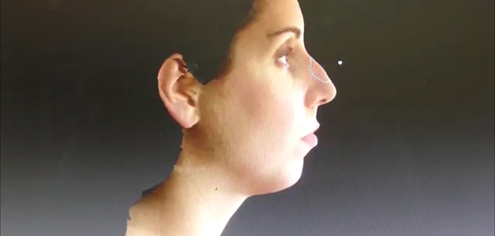 3-D imaging for rhinoplasty.