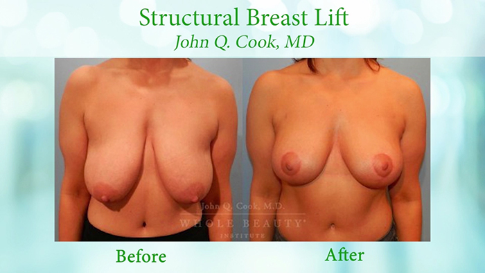 Structural breast lift with Dr. Cook.