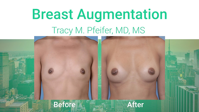 Breast augmentation results - Pfeifer.