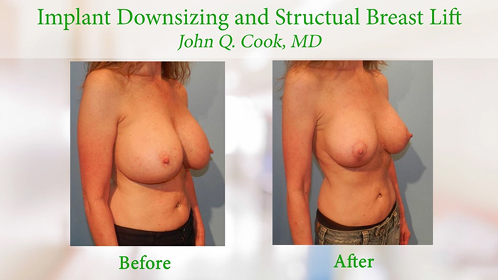 Structural breast lift before and after.