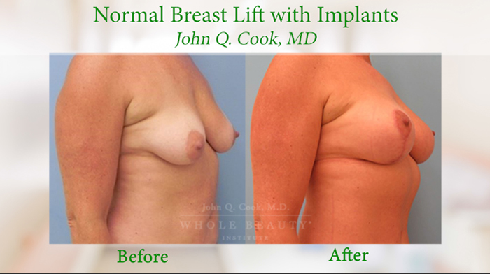 Normal Breast Lift - Dr. Cook.