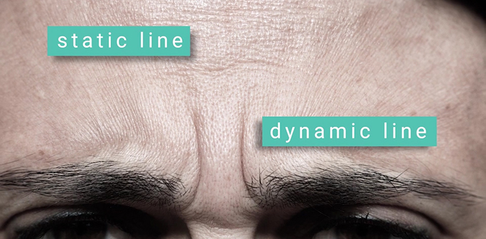 Botox - dynamic vs. static wrinkles.