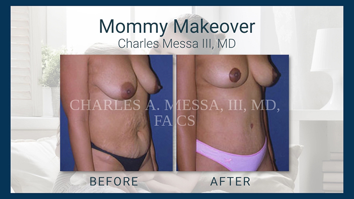 Charlie Messa mommy makeover results.