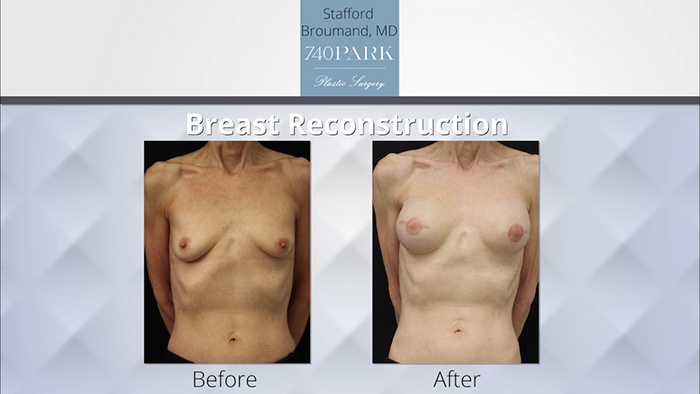Breast reconstruction - Broumand results.